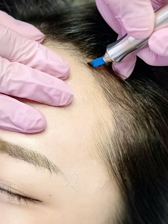 小顔に見せる効果もあるへアライン施術
©セカジソウォン医院 明洞店(TW ARTMAKE)