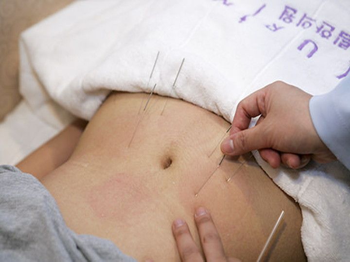 脂肪分解鍼は、鍼を通じて電気刺激を与える施術で、不要な脂肪を溶かし体外へ排出します。お腹や二の腕、脚など部分的に痩せたい場合に最適です。