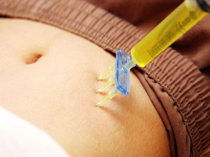 韓方ダイエットに使われる脂肪分解注射は、自然エキスで構成されたもの。循環を改善し、毒素と体脂肪を分解、排出を促して、むくみも和らげます。