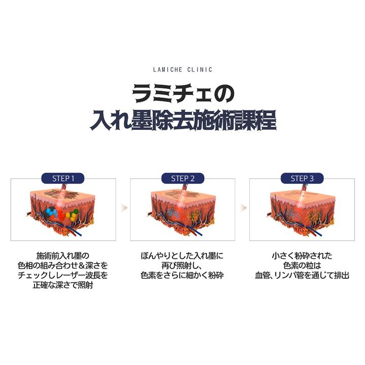 「入れ墨除去クリニック」の流れ