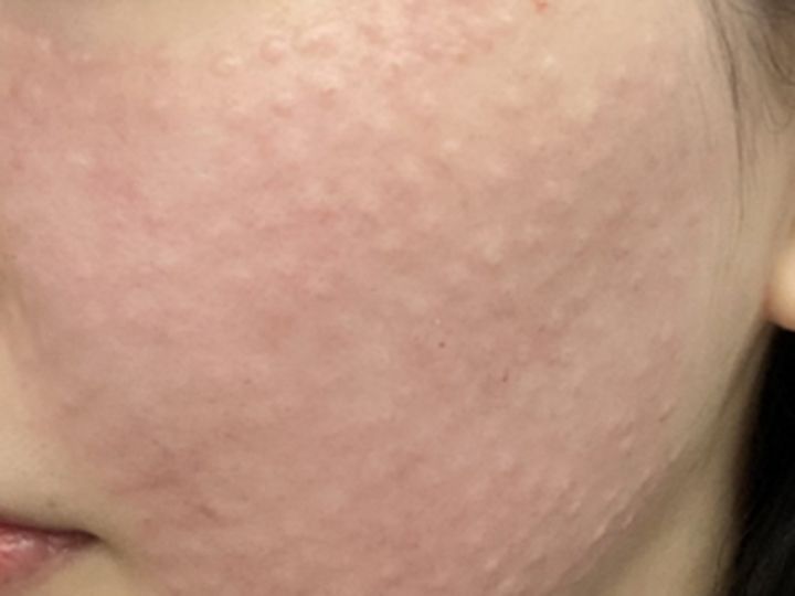 施術後のエンボス現象