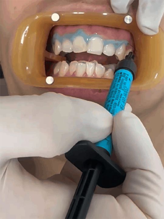 1.歯茎保護剤を塗布