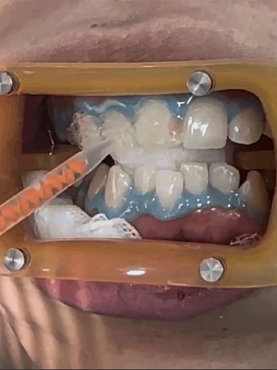 2.ホワイトニング薬剤を塗布