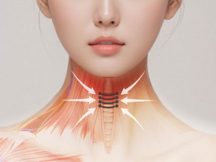 首の側面の広頚筋を中央に引き寄せ固定する