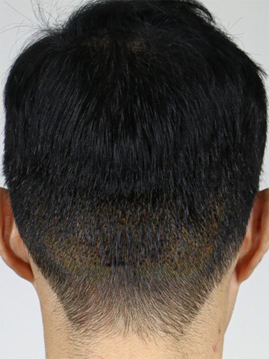 無剃髪2000本/手術翌日