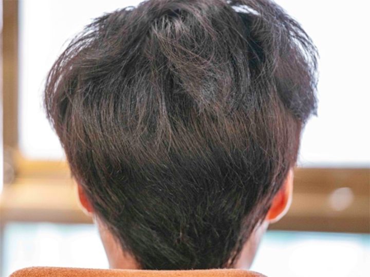 無剃髪3000本/手術翌日