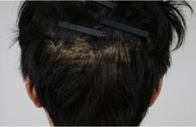 マイクロカット法
手術直後