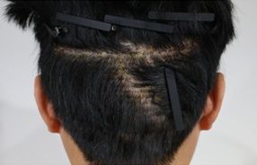 ラインカット法
手術直後