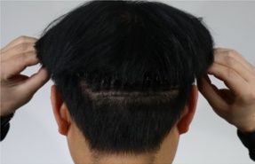 ラインカット法
手術2週間後