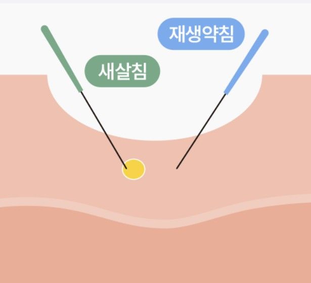 STEP1 特殊な鍼を利用して、皮膚の奥深くに癒着した組織を剥離します