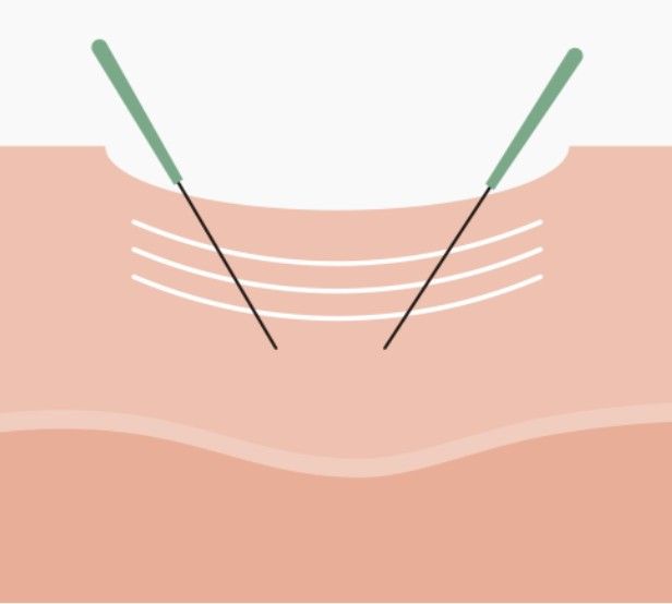 STEP3 複数回施術することによって皮膚が反復して再生することでへこみがだんだんと浅くなり、平らになります