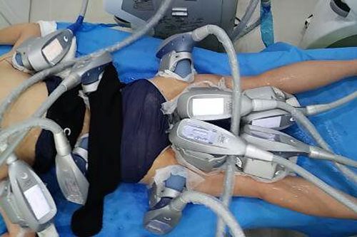 冷凍脂肪分解イメージ