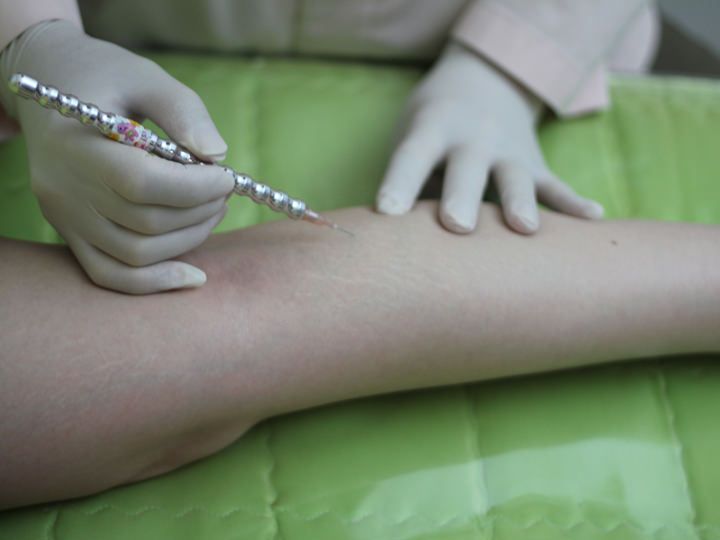 再生鍼施術イメージ