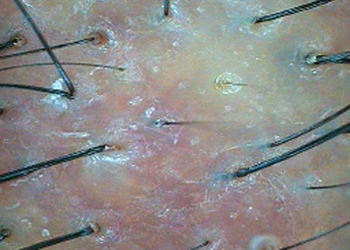 ダメージを受けた頭皮