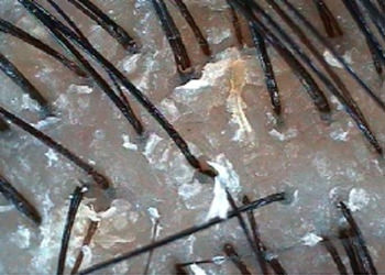 フケ、角質が多い頭皮